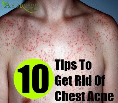 10 Tips To Treat Chest Acne Get Rid Of Chest Acne, Treating Cystic Acne, Hormonal Acne Remedies, Overnight Acne Remedies, Chest Acne, Baby Acne, Forehead Acne, Natural Acne Remedies, Hormonal Acne