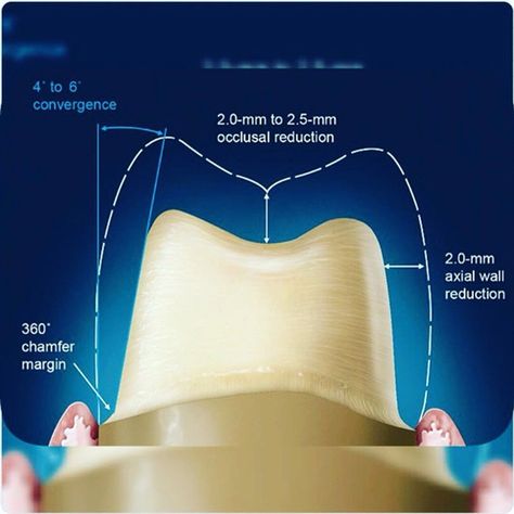 Dentaltown - Crowns are often used to improve the strength or appearance of teeth. The most common method of crowning a tooth involves using a dental impression of a prepared tooth by a dentist to fabricate the crown outside of the mouth. The crown can then be inserted at a subsequent dental appointment. Dental Photos, Dental Impressions, Dental Restoration, Dental Aesthetics, Dental Implant Surgery, Kedokteran Gigi, Dental Anatomy, Dental Implants Cost, Dental Facts