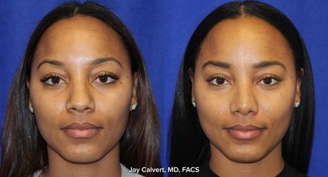 Nose Reduction, Ethnic Rhinoplasty, Rhinoplasty Nose Jobs, Rhinoplasty Before And After, Small Nose, Big Forehead, Big Nose, Bare Face, Nose Job