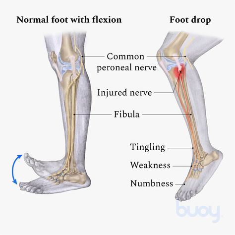 Peroneal (Fibular) Nerve Injury | What Causes It & How to Treat Knee Dislocation, Peroneal Nerve, Nerve Injury, Nerve Conduction Study, Knee Bones, Soft Tissue Injury, Muscle Knots, Bone Fracture, Peripheral Nerve