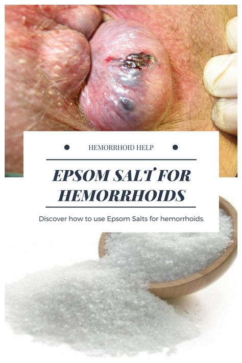 back pain relief Hemorrhoid Removal, Thrombosed Hemorrhoid, Hemorrhoid Remedies, Hemorrhoid Relief, Holistic Remedies, Epsom Salt, Health Check, Natural Home Remedies, Get Real