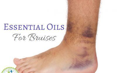 Essential Oils for Bruises: Have You Tried EOs For Bruising? #Nourishyourself #Nontoxichome #Nontoxicliving #Nontoxicskincare #Fitforme #Justbreathe #Lookwithin #Mantramonda #Essentialoil #Essentialoils Essential Oil For Bruising, Acne Essential Oil, Essential Oil For Hair, Oils For Sinus, Essential Oils 101, Essential Oils For Pain, Essential Oils For Headaches, Essential Oil Remedy, Benefits Of Essential Oils