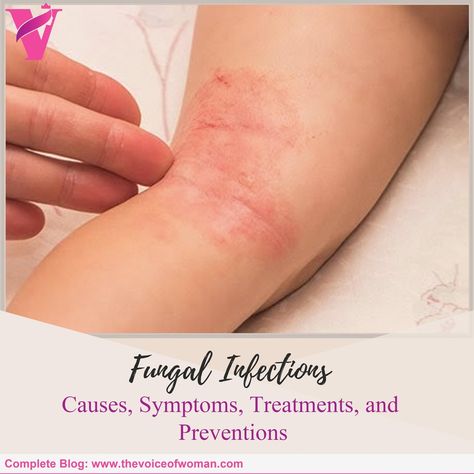 Do you know the root cause of #fungal infections in #humans? In a human body, a fungal infection occurs when an infecting #fungus retains an area of the body that is excessive for the #immune system to deal with. Plus, some fungi are present naturally in the human body.⠀ ⠀ Like any other #microbes, there are both harmful as well as helpful fungi. If a harmful fungus invades into your body, then it becomes difficult to #kill them, as these fungi tend to survive in the #environment which directly Skin Fungus, Fungal Infection Skin, Nail Infection, Fungal Nail, Nutrition Drinks, Human Body Systems, Natural Antibiotics, Fungal Infection, Nail Fungus