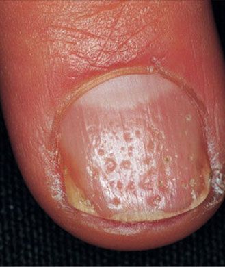 Pitting and Grooving-Depressions and small cracks in your nails are known as “pitting” of the nail bed and are often associated with psoriasis, an inflammatory disease that leads to scaly or red patches all over the body. “Individuals who suffer from psoriasis develop clusters of cells along the nail bed that accumulate and disrupt the linear, smooth growth of a normal nail,” Dr. Agarwal explains"-----pinned by Annacabella Nail Health Problems, Pitted Nails, Fingernail Health, Pale Nails, Nail Disorders, Nail Ridges, Nail Conditions, Nail Problems, Nail Beds