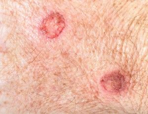 5 Warning Signs of Basal Cell Carcinoma Basil Cell Carcinoma, Basal Cell, Skin Bumps, Squamous Cell, Skin Disorders, Warning Signs, Skin Health, Skin Cells, Basil