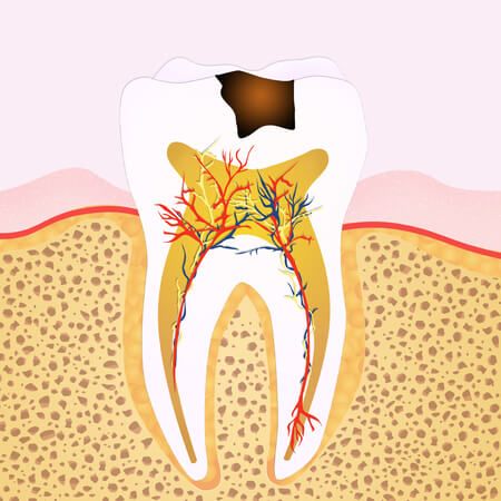 Impacted Wisdom Teeth, Tooth Nerve, Tooth Extraction Healing, Tooth Infection, Sensitive Teeth Remedy, Remedies For Tooth Ache, Dental Surgeon, Loose Tooth, Tooth Pain