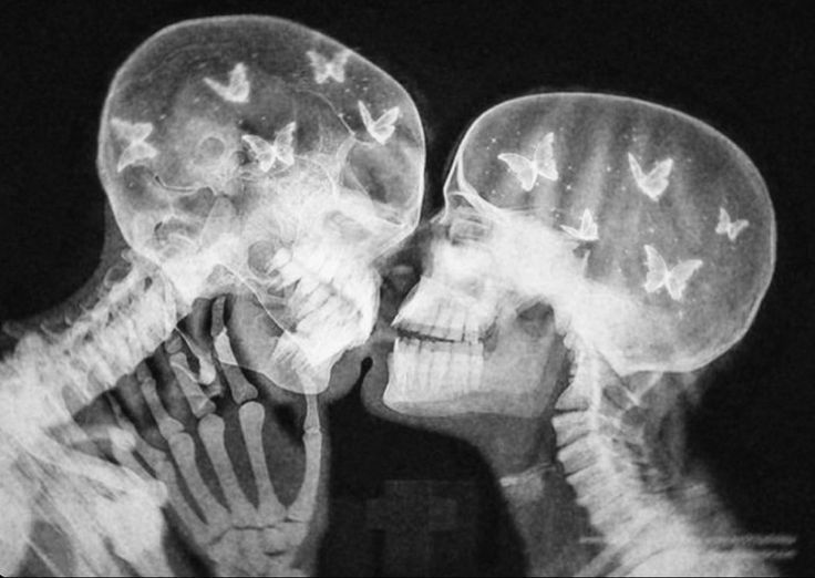 x - ray image of two people kissing with butterflies on their heads and the skeleton behind them