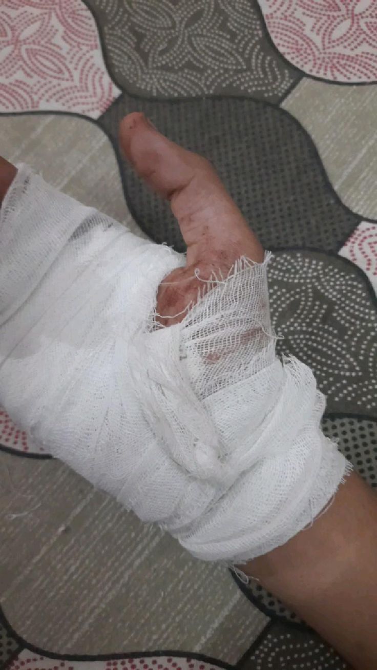 Fake Bandage Snap, Accident Snap Ideas, Accident Snap Ideas Hand, Fake Hospitalized Snaps, Bandage Snap, Accident Hand, Sick Snap, Blood Pic, Hospital Snap