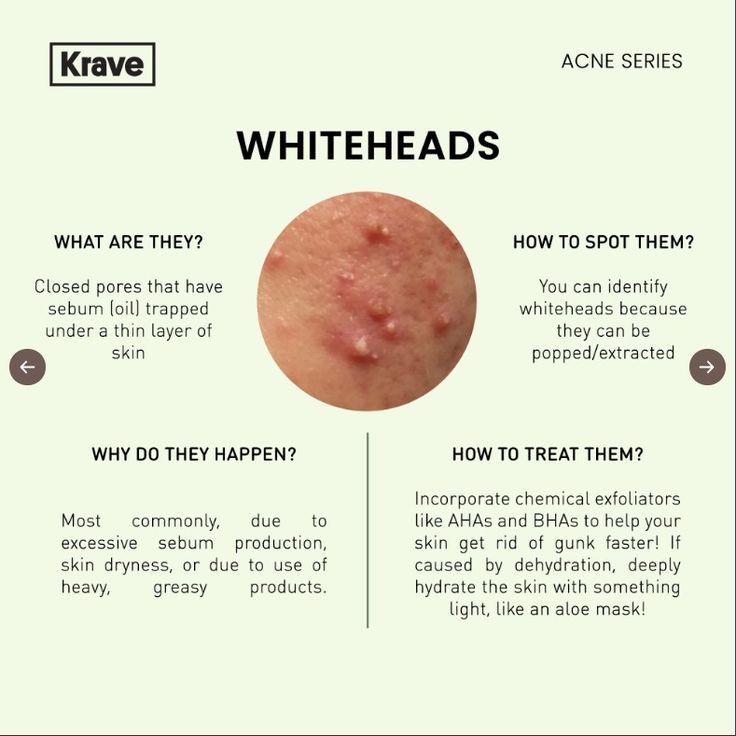 Tackling acne can be a long journey, but you don't have to feel lost! First things first, know what you're dealing with 🙌 Dermatology Notes, Whiteheads On Chin, Skincare Notes, Esthetician Knowledge, Acne Quotes, Acne Awareness, Esthetician Skincare, Beauty Skin Quotes, Skin Facts