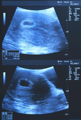 an x - ray image of a woman's breast is shown in three different views