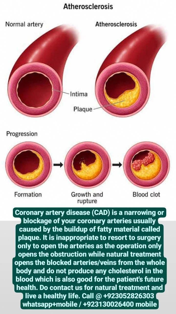 Blood Sugar Tracker, Coronary Artery, Arteries And Veins, Blood Sugar Diet, Coronary Arteries, Health And Fitness Magazine, Medical Anatomy, Healthy Diet Tips, Daily Health Tips