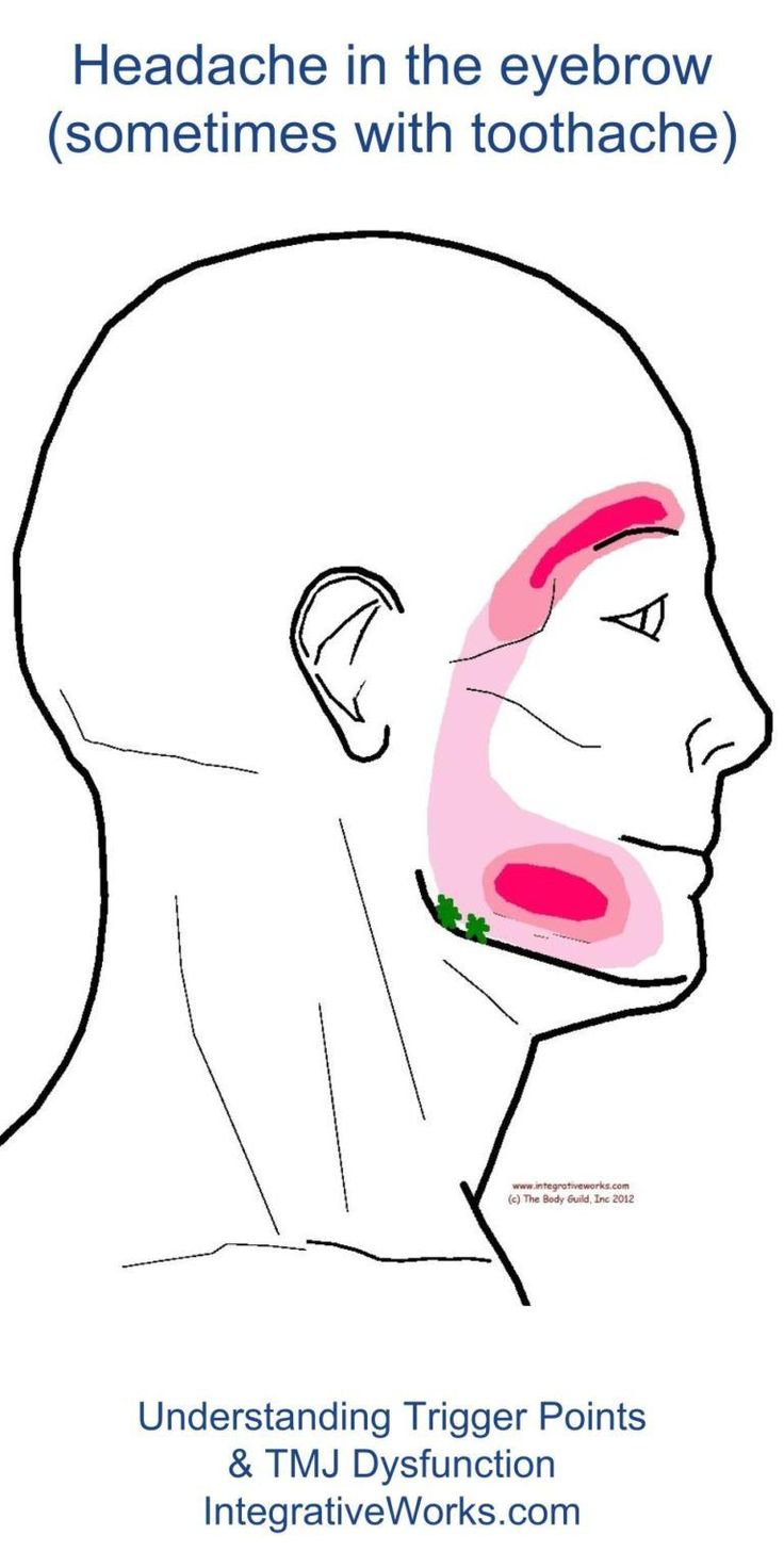 fi-headache-in-brow-with-toothache #chronicmigraine Dental Health Kindergarten, Punkty Spustowe, Kids Dental Health, Dental Health Care, Chronic Migraines, Receding Gums, Oral Care Routine, Trigger Points, Teeth Care