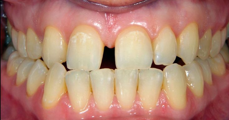 Curious what's making your teeth yellow? One of these reasons could be the cause... Yellow Teeth Aesthetic, How Many Teeth Do We Have, Golden Teeth, Rebuild Enamel On Teeth, Teeth Yellow, Yellow Tongue, Teeth Aesthetic, Dental Tips, Yellow Teeth