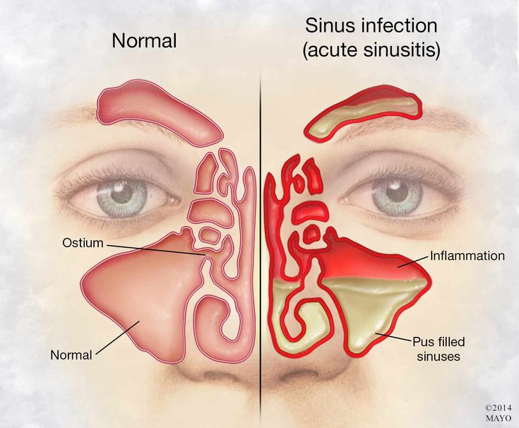 Treating Sinus Infection, Relieve Sinus Congestion, Acute Sinusitis, Remedy For Sinus Congestion, Sinus Remedies, Home Remedies For Sinus, Maxillary Sinus, Sinus Congestion Relief, Sinus Infection Remedies