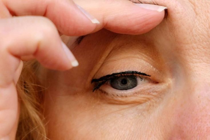 Ptosis: What You Need to Know About Eyelid Drooping and How to Fix It  - Crave Magazine Drooping Eyelid, Muscle Diseases, Drooping Eyelids, Droopy Eyelids, Upper Eyelid, Boost Collagen Production, Lifestyle Habits, Neurological Disorders, Eye Strain