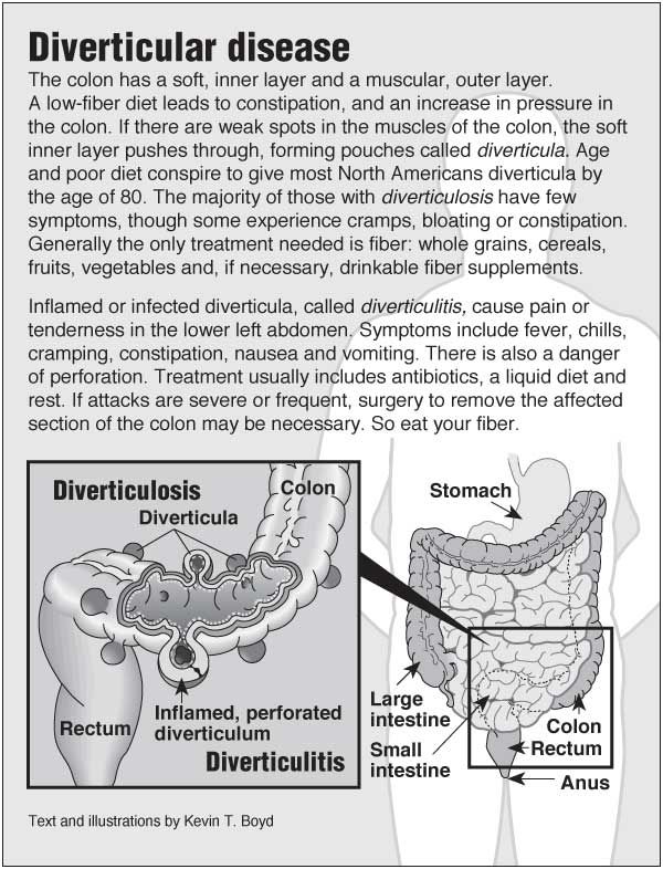 Information graphic about diverticulosis and diverticulitis with links to acupressure for related symptoms Diviticulitis Diet, Sigmoid Colon, Health Infographics, Low Fiber Diet, Colon Health, Gut Healing, Nursing Notes, Medical Knowledge, Nclex