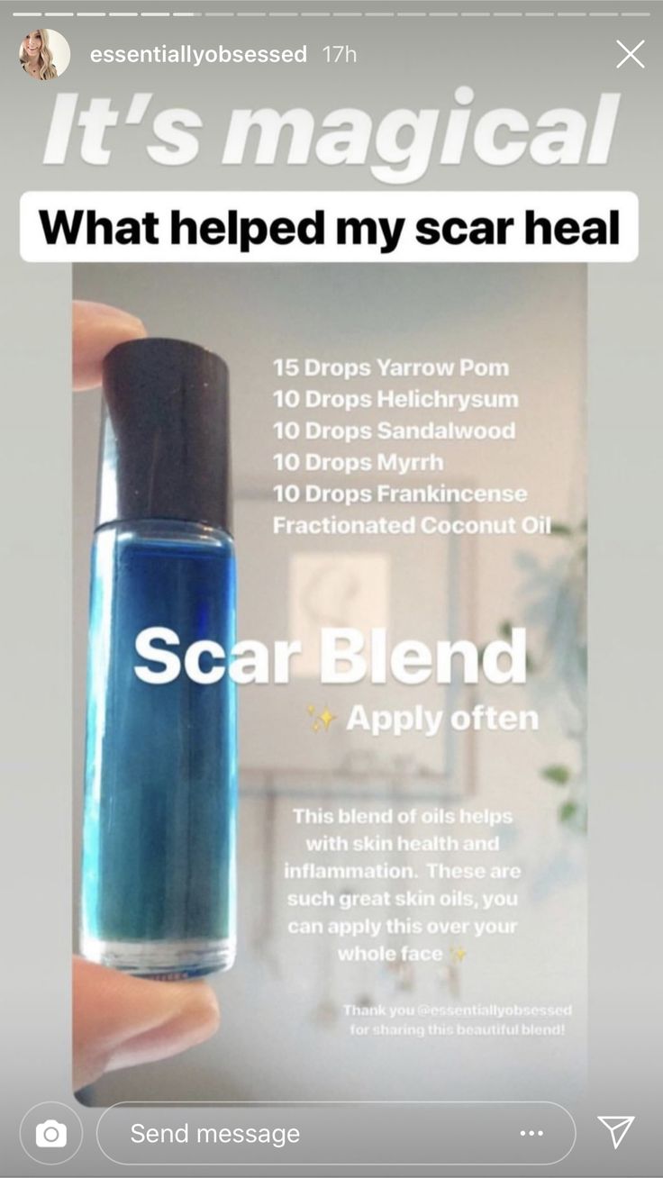 Essential oil blend to heal scars Oils For Scars, Roller Bottle Recipes, Roller Blends, Medicine Tips, Doterra Essential Oils Recipes, Remedies For Cough, Eye Exercises, Cold Sores Remedies, Oil Roller