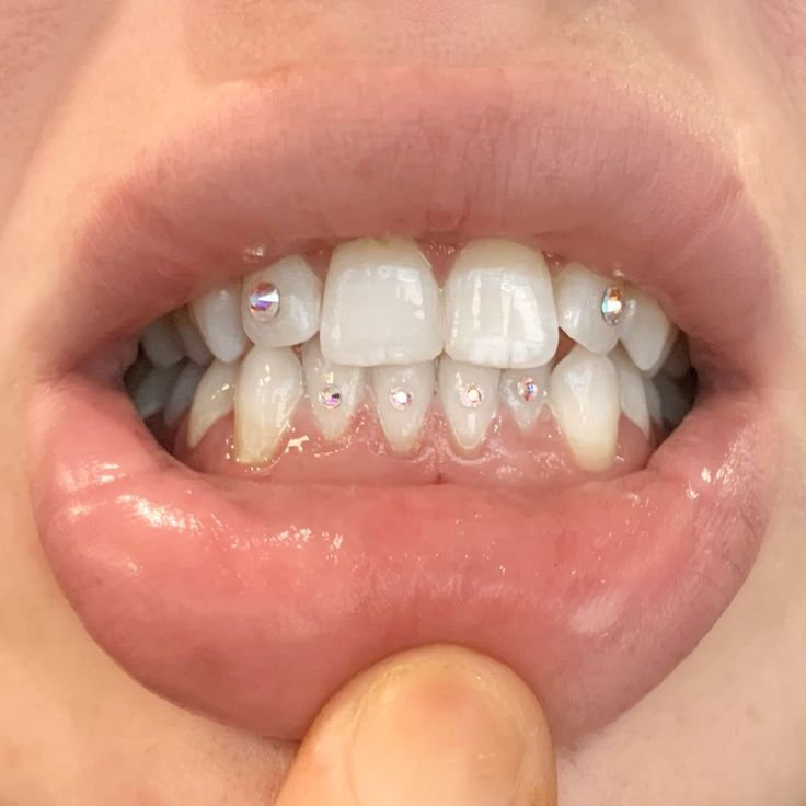 a close up of a person's mouth with teeth and gums on it