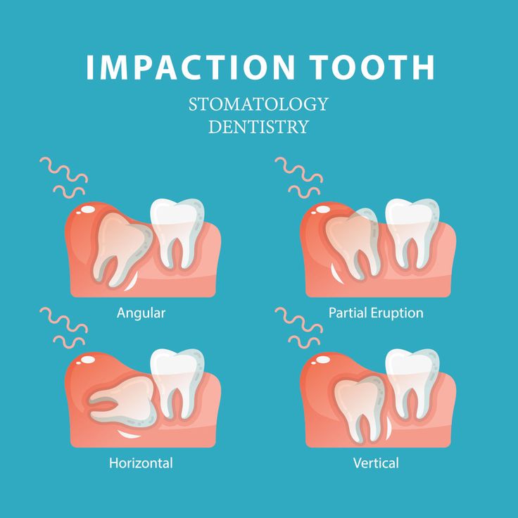 Impacted wisdom teeth can cause pain, swollen gums & swelling around the jaw. To avoid these problems, have your wisdom teeth fixed right away. Call us today at 702-671-0001 or visit us at: https://www.functionalaestheticdentistry.com/3-warning-signs-of-impacted-wisdom-teeth/ #DrSuffoletta #dentist #wisdomteeth #DentalOffice #Dentistry #Oral Wisdom Teeth Recovery, Impacted Wisdom Teeth, Wisdom Teeth Pain, Tooth Pain Relief, Impacted Tooth, Sensitive Teeth Remedy, Remedies For Tooth Ache, Wisdom Tooth, Laser Dentistry