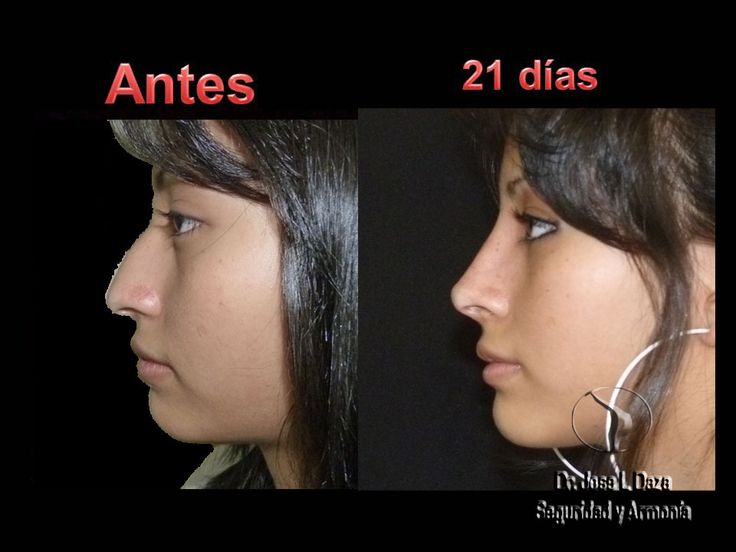 Rinoplastia, Cirugía de la Nariz | Cirugía Plástica Estética y Reconstructiva México Noise Job, Dream Nose, Nose Plastic Surgery, Nose Surgery Rhinoplasty, Nose Jobs, Facial Procedure, Rhinoplasty Nose Jobs, Nose Reshaping, Perfect Nose