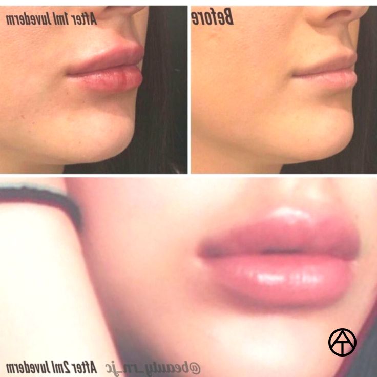 1Ml Juvederm Before And After Lips Juvederm Dermal