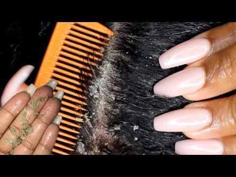 Scalp scratching and picking | Satisfying Dandruff Removal ASMR | Psoriasis - Yo...,  #ASMR #Dandruff #picking #Psoriasis #Removal #Satisfying #scalp #scratching #Yo Check more at https://hairsmoothening.com/scalp-scratching-and-picking-satisfying-dandruff-removal-asmr-psoriasis-yo/ Scalp Psorasischic, Scalp Bumps, Dandruff Scratching, Pimples On Scalp, Sores On Scalp, Shampoo Diy, Dandruff Removal, Hair Mask For Dandruff, Dandruff Causes