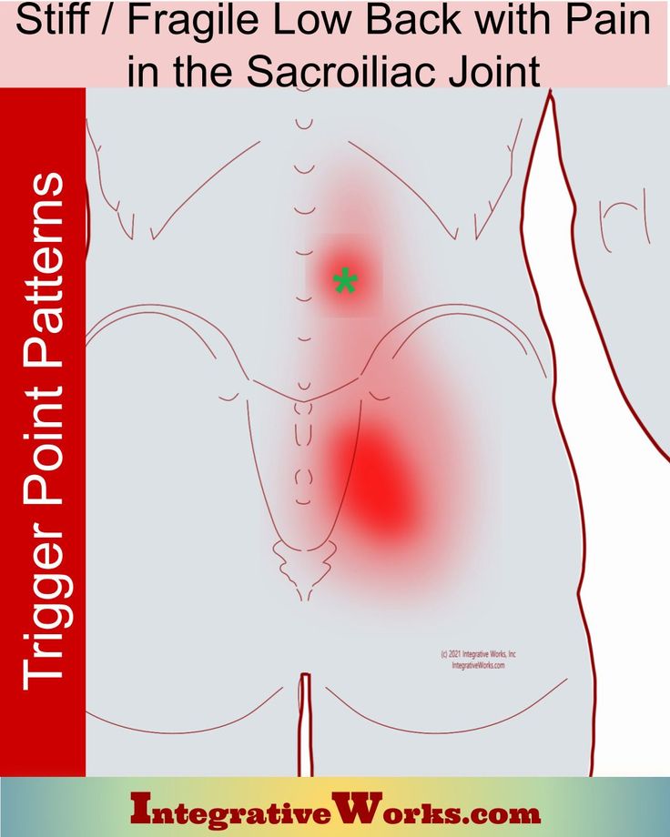 How people describe this pain. Activities that aggravate it. Links to self-care, anatomy and massage notes. Si Dysfunction, Knee Pain Exercises, Trigger Point, Knee Pain Relief, Sciatica Pain, Relieve Back Pain, Trigger Points, Hip Pain, Hip Workout