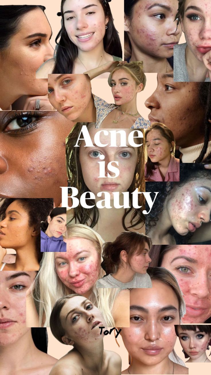 Girl With Acne Aesthetic, Girl With Acne, Celebrity Acne, Acne Makeup, Bare Beauty, Love Your Skin, Pretty Skin, Acne Skin, Face Skin Care