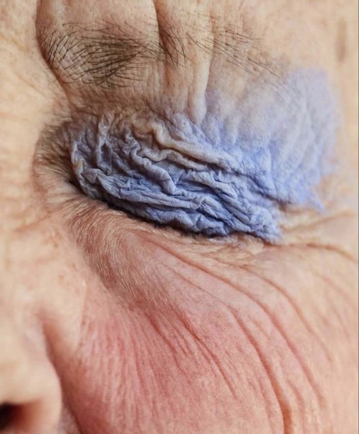 an older man's eye with wrinkles and blue thread on the iris area