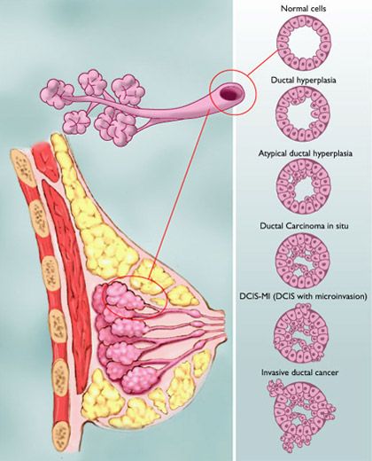 Abnormal Cells, Breast Reduction, Breast Health, Types Of Cancers