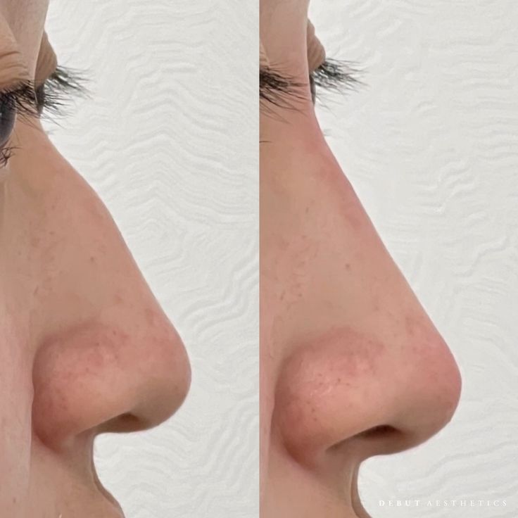 Nose filler, also known as non-surgical rhinoplasty, is a quick and effective procedure to smooth out bumps and straighten the bridge of the nose without the need for surgery. Just take a look at these incredible results! 💫 With just a few strategic and precise injections, Dr. Brock can sculpt your nose to achieve a smoother, more symmetrical profile from every angle. If you're searching to enhance your facial harmony or boost your confidence, nose filler can help you achieve the look you... Nose Filler, Nose Fillers, Bent Nose, Curved Nose, Flat Nose, Nose Job, Surgery, Bridge, Facial