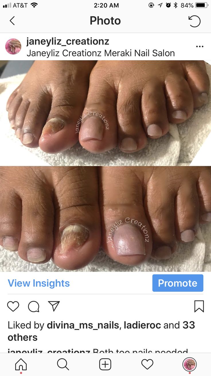 Acrylic Overlay, Pedicures, Get Better, Take Out, Nail Tech, Toe Nails, Everyday Life, You Nailed It, Sandals