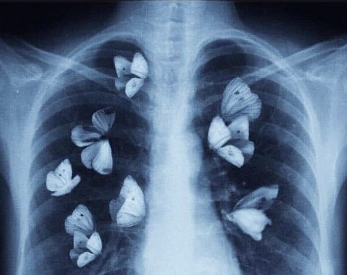 an x - ray image shows the lungs with small flowers on their chest and ribs