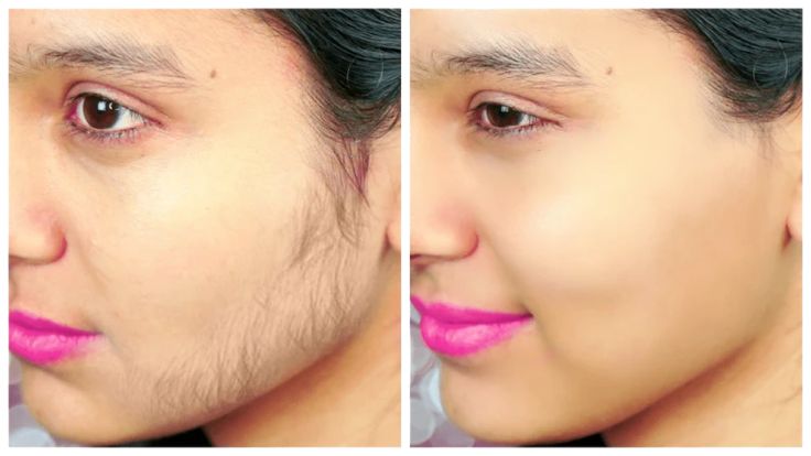 How to Stop Facial Hair Growth in Females Naturally | KetchBeauty Remove Face Hair, Stop Facial Hair Growth, Female Facial Hair, Lip Hair Removal, Upper Lip Hair, Facial Hair Growth, Face Hair Removal, Remove Unwanted Facial Hair, Laser Hair Removal Device