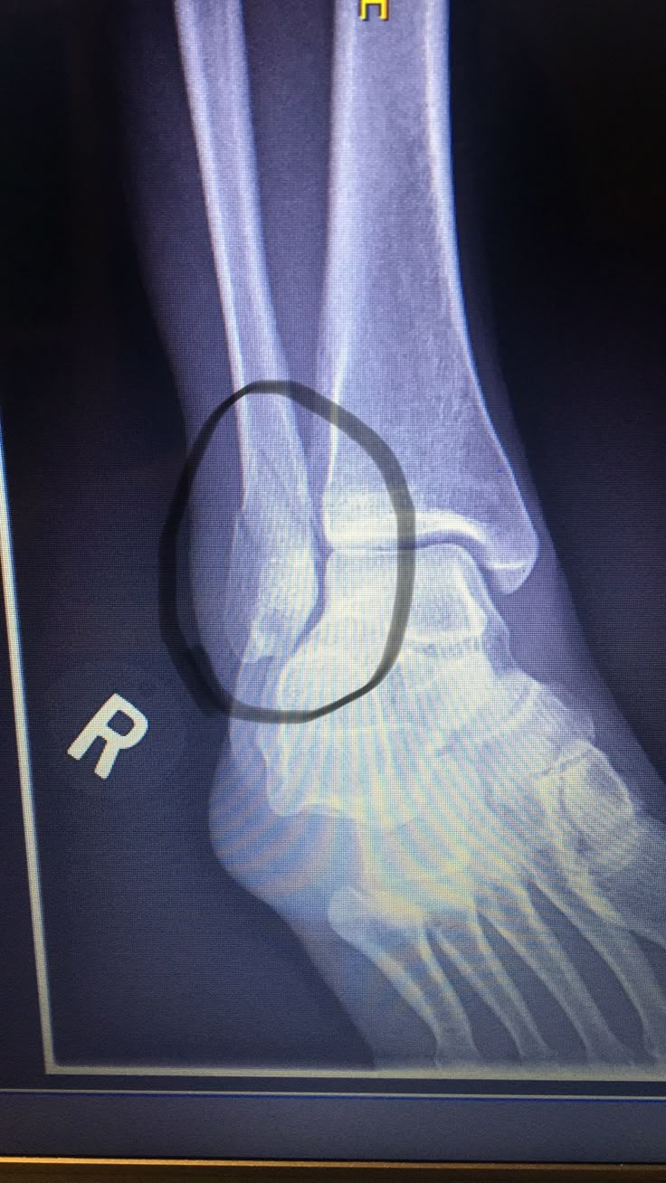 an x - ray image of a foot with the letter q on it's side