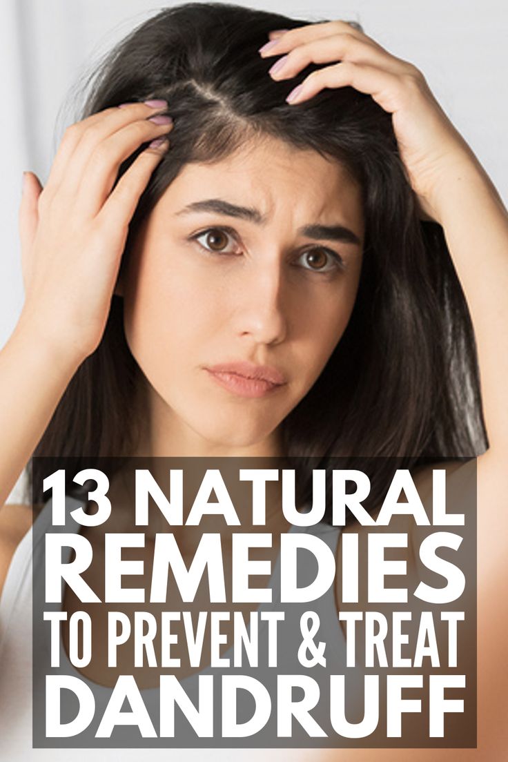 13 Home Remedies for Dandruff | Dry scalp got you down? If you want to know how to get rid of dandruff and the flakes it brings along with it without harsh chemicals and store bought products, we’re sharing 6 homemade remedies you can start using today for results that last. Using things you already have on hand, like baking soda, coconut oil, and aloe vera, these natural treatments work! #dandruff #dandruffremedies #dryscalp Itchy Scalp Remedy, Dry Scalp Remedy, Natural Dandruff Remedy, Dandruff Causes, Home Remedies For Dandruff, Dandruff Remedy, Getting Rid Of Dandruff, Natural Remedies For Migraines, Hair Dandruff