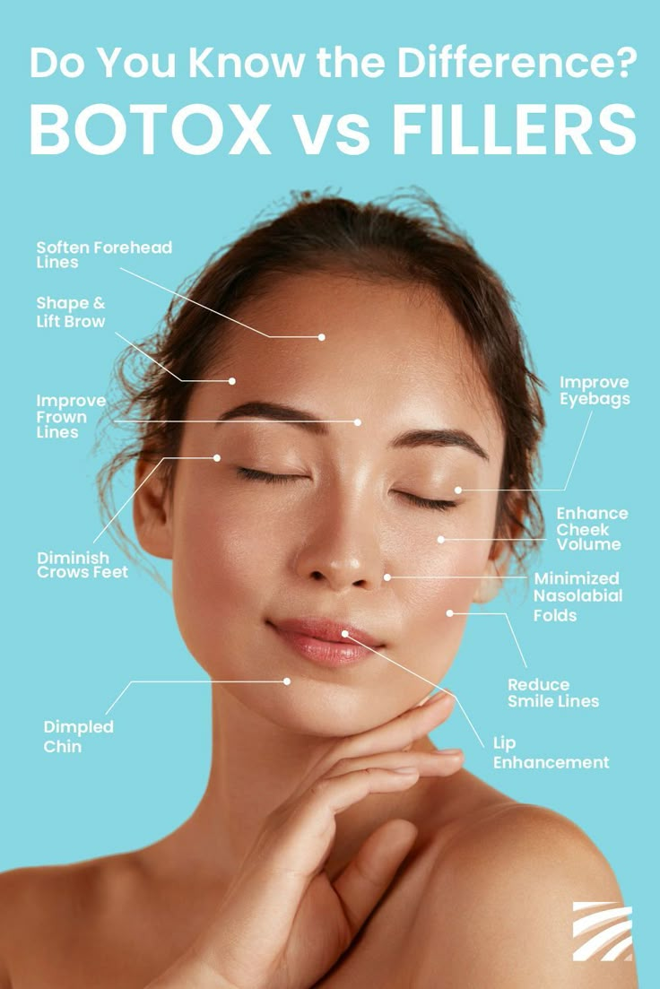 Botox Vs Fillers, Botox Under Eyes, Derma Fillers, Under Eye Fillers, Botox Before And After, Face Fillers, Homemade Face Mask, Hyaluronic Acid Fillers, Botox Face