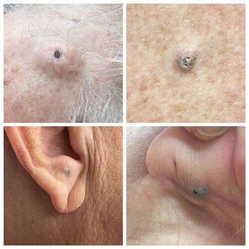 Gigantic Blackheads: What Is a Dilated Pore of Winer? – SLMD Skincare by Sandra Lee, M.D. - Dr. Pimple Popper Pimple Under The Skin, How To Treat Pimples, Blackheads On Back, Zit Popping Video Faces, Deep Pimple, Huge Blackheads, Big Zits, Closed Comedones, Huge Pimple