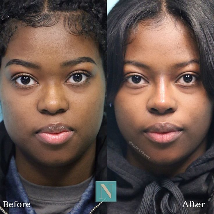 Rhinoplasty Before And After Black Women, Small Nose Tip, Ethnic Rhinoplasty African Americans, Black Rhinoplasty, Lower Blephoraplasty Before And After, Rhinoplasty Before After, Ethnic Nose Job, Feminine Goals, Kpop Plastic Surgery