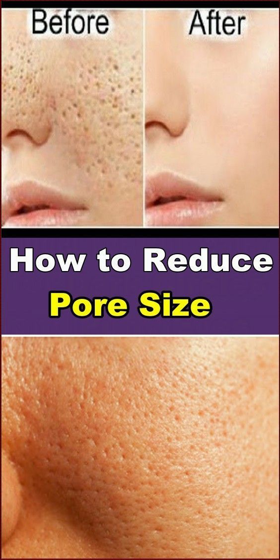 Open Pores On Face, Pores On Face, Big Pores, Reduce Pore Size, Natural Toner, Open Pores, Reduce Pores, Baking Soda Shampoo, Remove Dark Spots