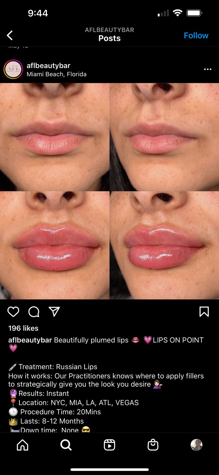 an image of lips before and after using lip fillers