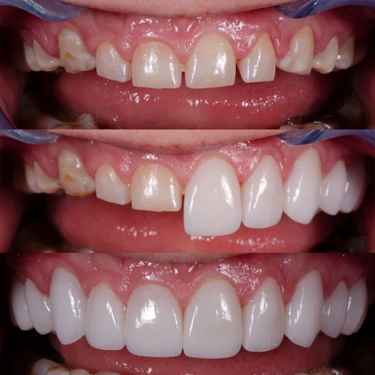 Teeth Implants Before And After, Dental Veneers Before And After, Dental Before And After, Porcelain Veneers Before And After, Dental Implants Before And After, Invisalign Before And After, Veneers Before And After, Veneer Teeth, Teeth Veneers