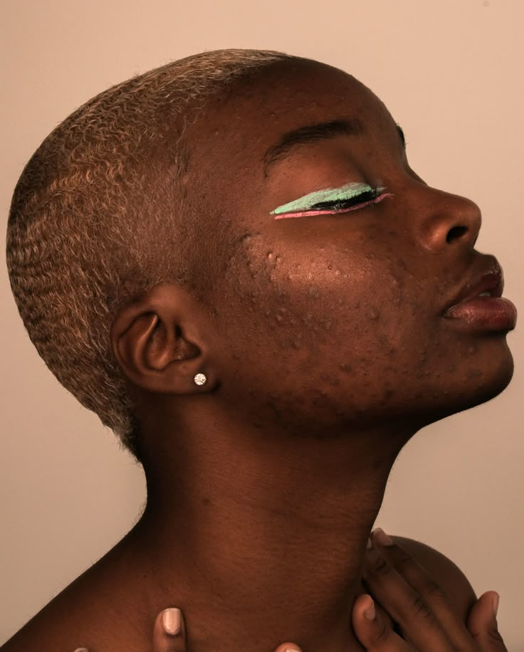 model: @nazhayabarcelona Acne Positivity Art, Models With Acne, Acne Black Women, Pretty People With Acne, Girls With Acne, Peter Devito, Acne Girl, Acne Photos, Acne Is Normal