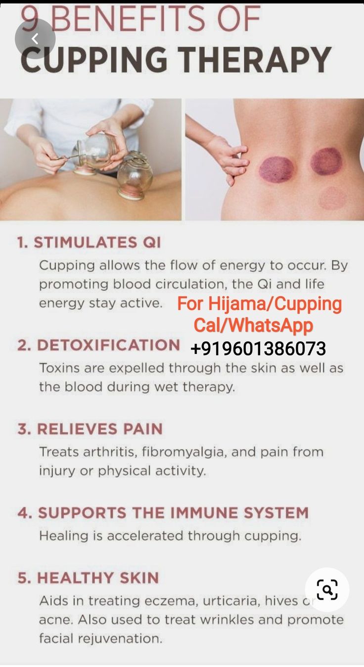 Shoulder Cupping Points, Back Cupping Therapy, Cupping Marks Meaning, Fire Cupping Therapy, Cupping Therapy Placement Chart, Dry Cupping Therapy Chart, Cupping Before And After, Hijama Cupping Therapy Benefits, Benefits Of Cupping Therapy