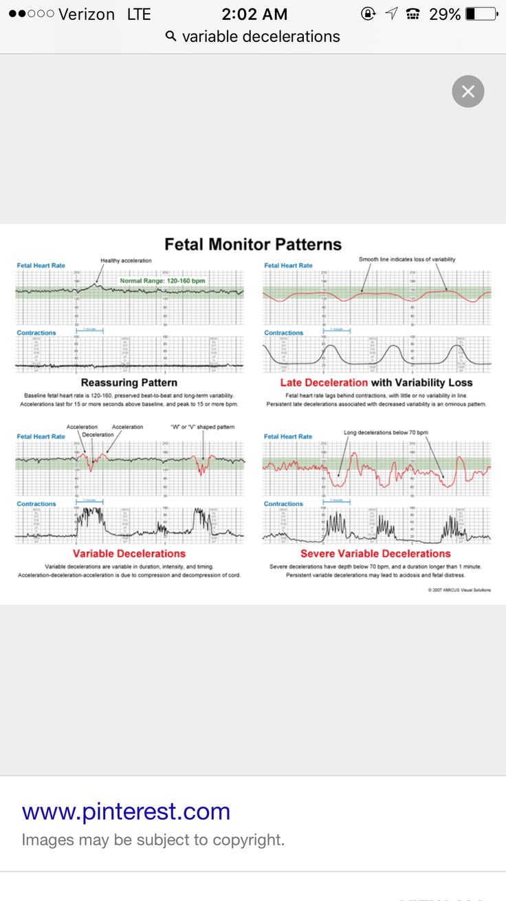 Maternal Nursing, Fetal Monitoring, Fetal Heart Rate, Nurse Teaching, Newborn Nursing, Veal Chop, Ob Nurse, Child Nursing, Labor Delivery Nursing