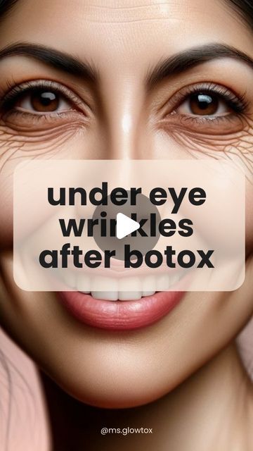 5,846 likes, 270 comments - ms.glowtox on January 31, 2024: "READ CAPTION FOR SOLUTIONS!  If this is happening to you, you can:  ✔️Use a lower dose so the outside of the eye maintains some movement, preventing the undereye from working too hard  ✔️Stay higher up so the lower portion of the crows feet absorbs some movement as opposed to only the under eye  Both of these may require embracing some wrinkles💗 BUT you can also:   ✔️Consider botox under the eye in very small amounts to soften the ... Under Eye Wrinkles Filler, Under Eye Botox Before And After, Botox Around Eyes, Undereye Filler Before And After, Botox Under Eyes Before And After, Botox For Hooded Eyelids, Under Eye Filler Before And After, Under Eye Wrinkles Remedies, Baking Soda Under Eyes