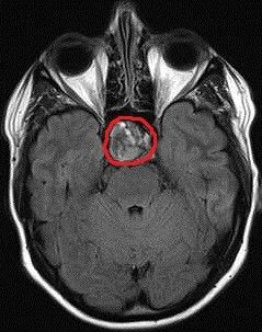 Pituitary Gland Tumor, Adrenal Fatigue Diet, Radiologic Technology, Cushings Syndrome, The Endocrine System, Brain Images, Endocrine Disorders, Adrenal Health, Psychological Effects