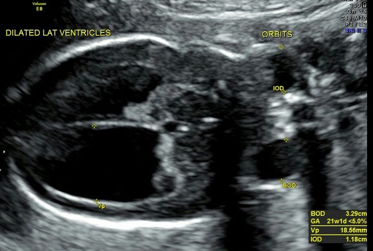 Semilobar holoprosencephaly Obstetric Ultrasound, Ultrasound Sonography ...