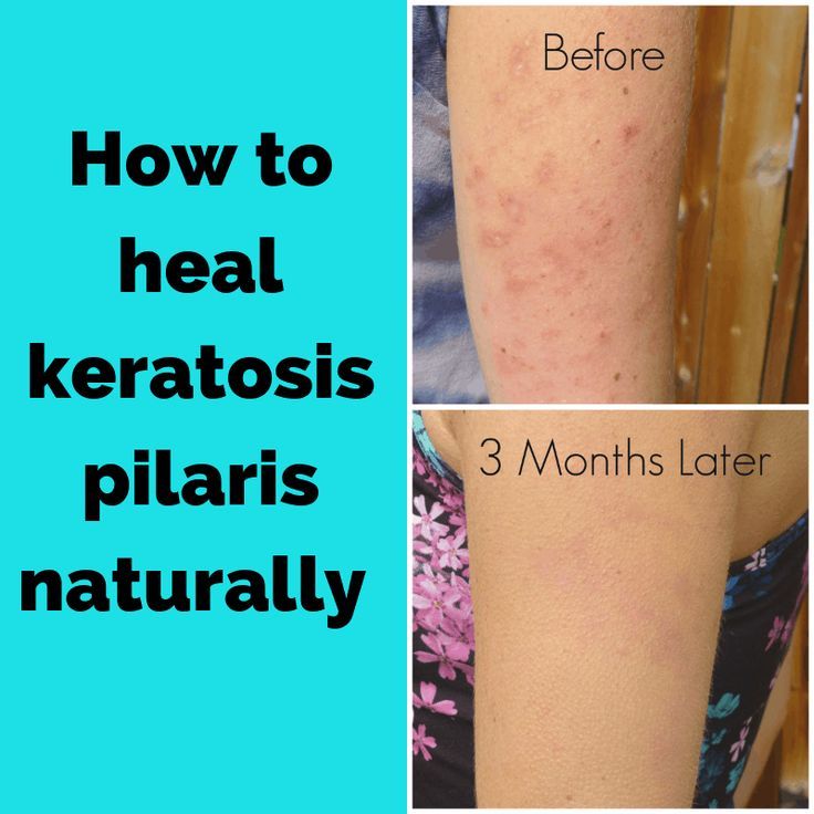 Chicken Skin Remedy, Arm Acne, Keratosis Pilaris Remedy, I Healed, Skin Bumps, Facial Products, Keratosis Pilaris, Bumpy Skin, How To Get Rid Of Pimples