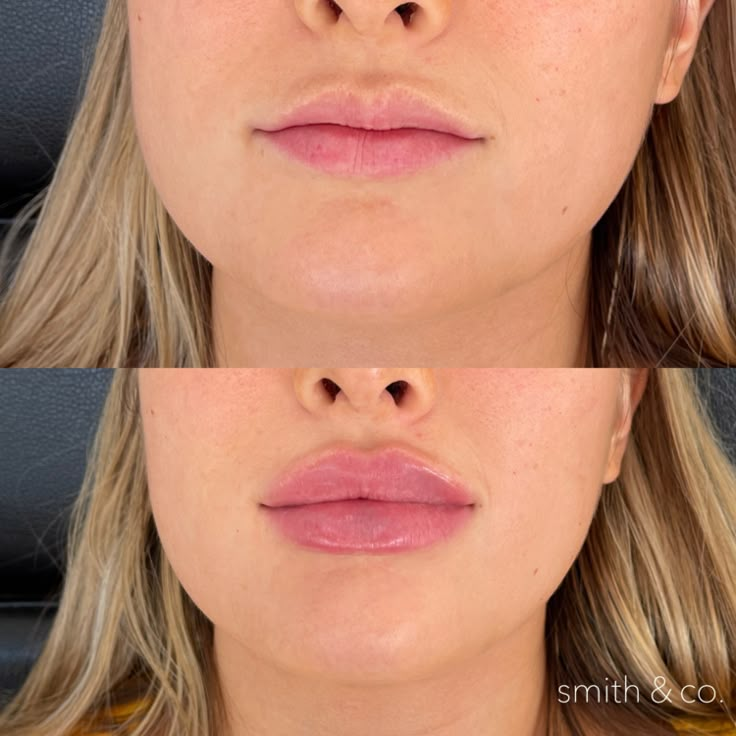 Allergan Botox, Dermal Fillers Lips, Fuller Lips Naturally, Aesthetic Medical, Face Treatments, Lips Inspiration, Face Fillers, Botox Lips, Facial Fillers